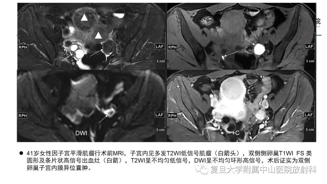 影像PPT - 【病例】子宫腺肌瘤1例MR影像-16