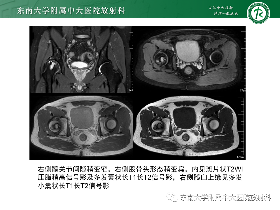 影像PPT - 【PPT】股骨头坏死-4