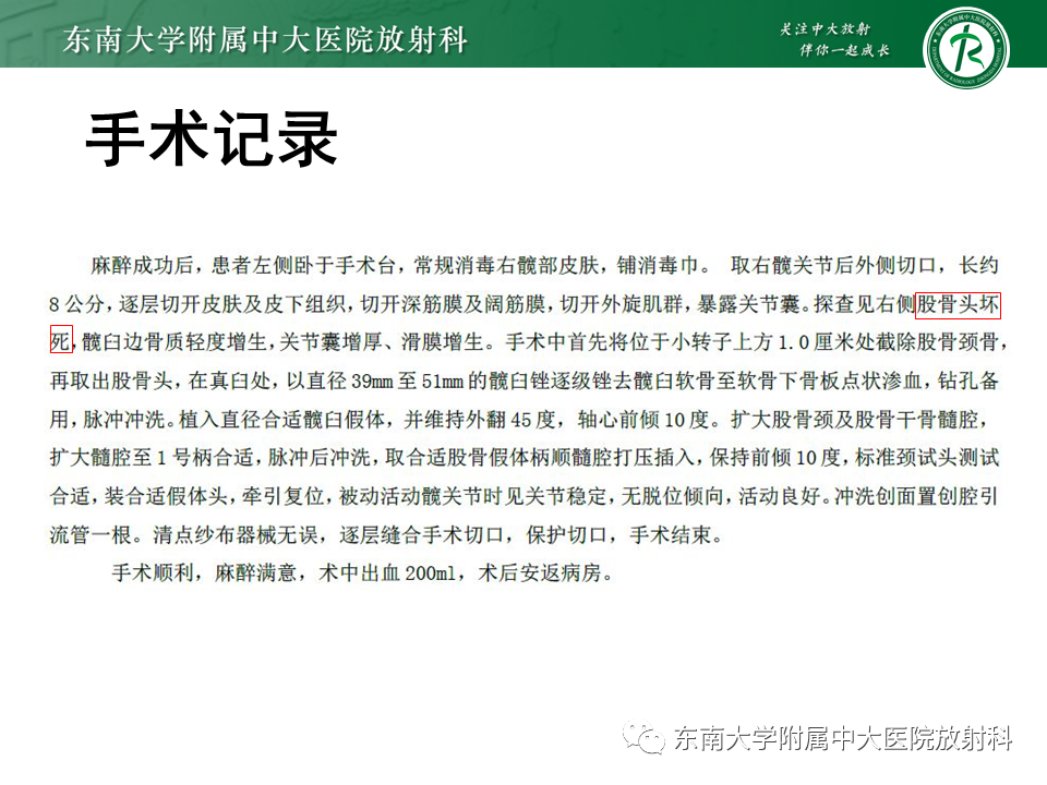 影像PPT - 【PPT】股骨头坏死-5