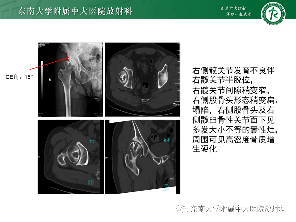 影像PPT - 【PPT】股骨头坏死-3
