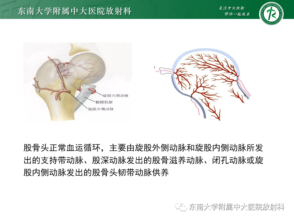 影像PPT - 【PPT】股骨头坏死-9