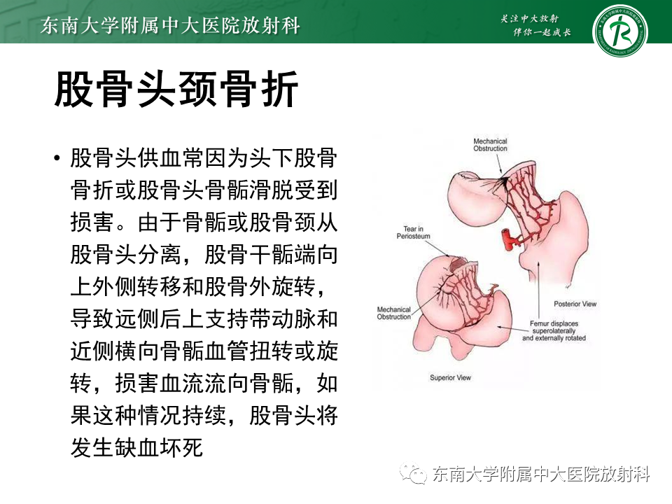 影像PPT - 【PPT】股骨头坏死-10