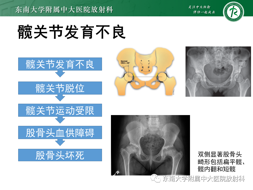 影像PPT - 【PPT】股骨头坏死-11