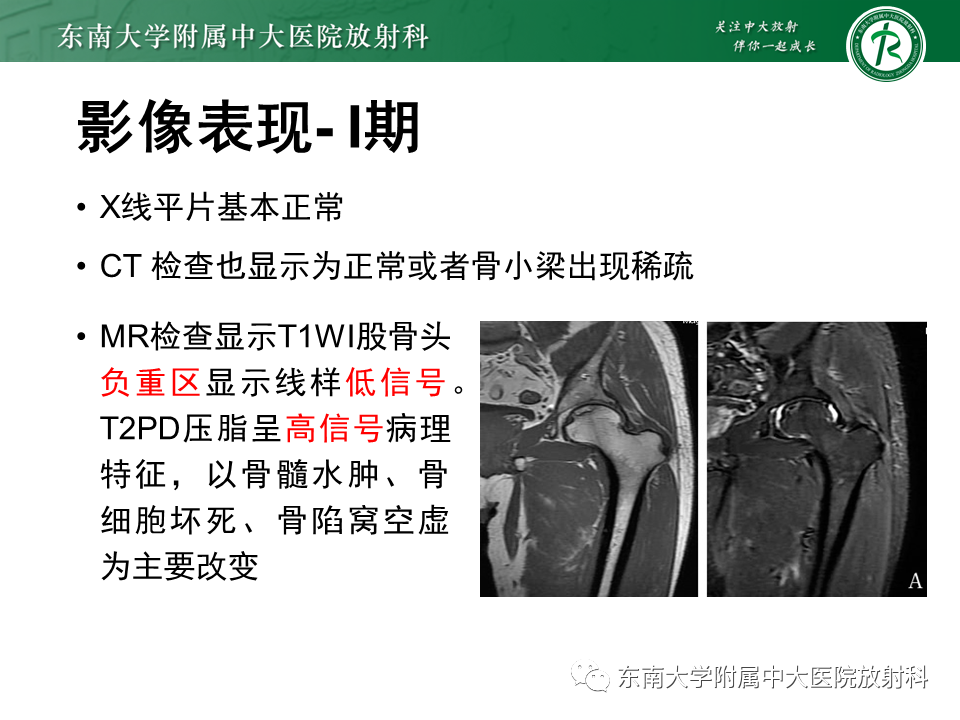 影像PPT - 【PPT】股骨头坏死-15