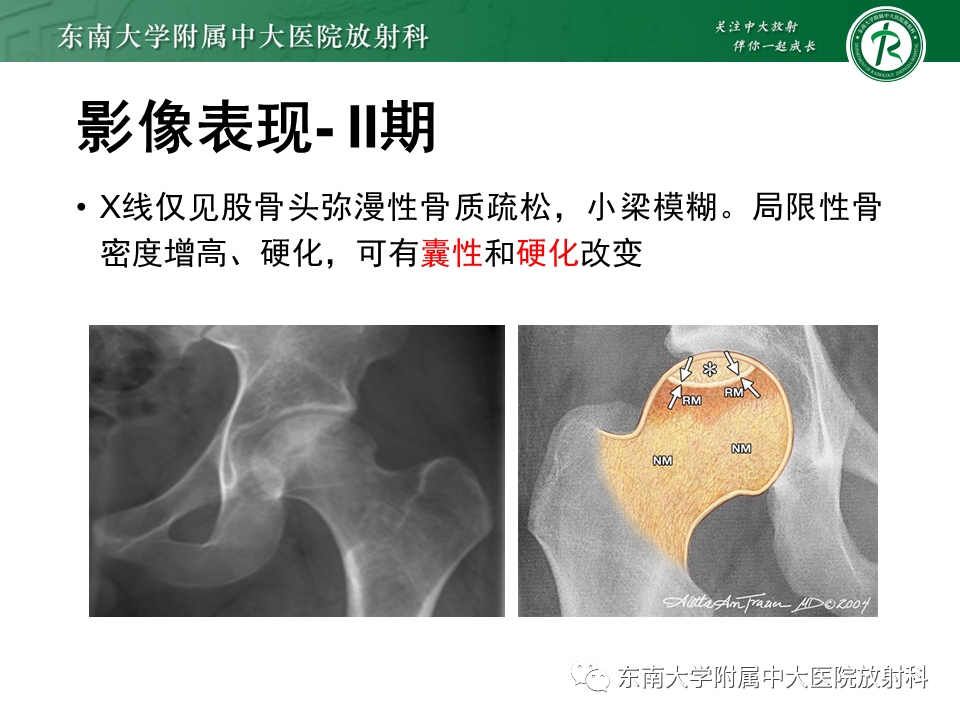影像PPT - 【PPT】股骨头坏死-16