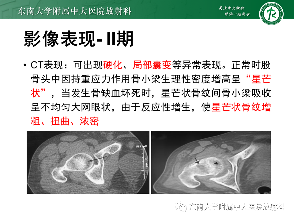 影像PPT - 【PPT】股骨头坏死-17