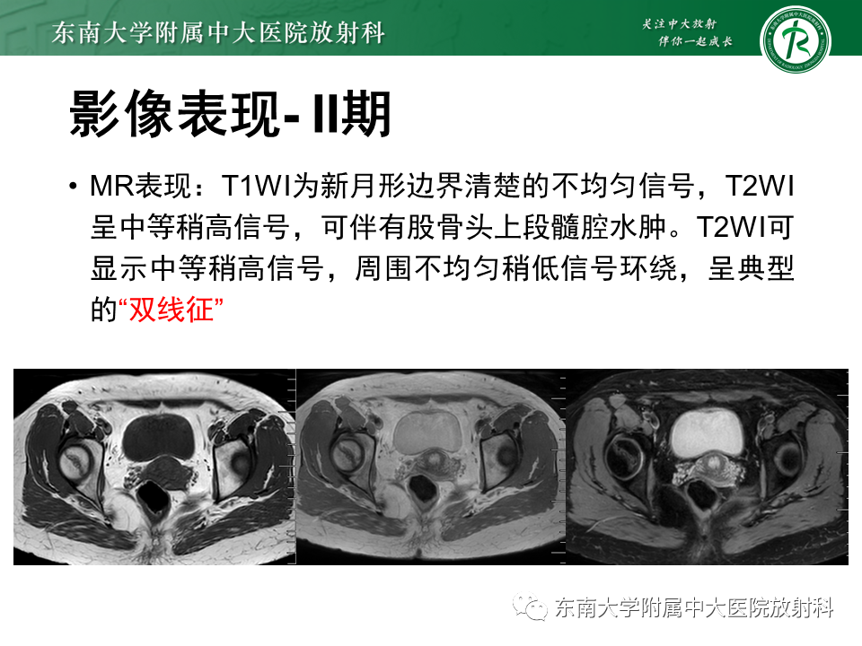 影像PPT - 【PPT】股骨头坏死-18