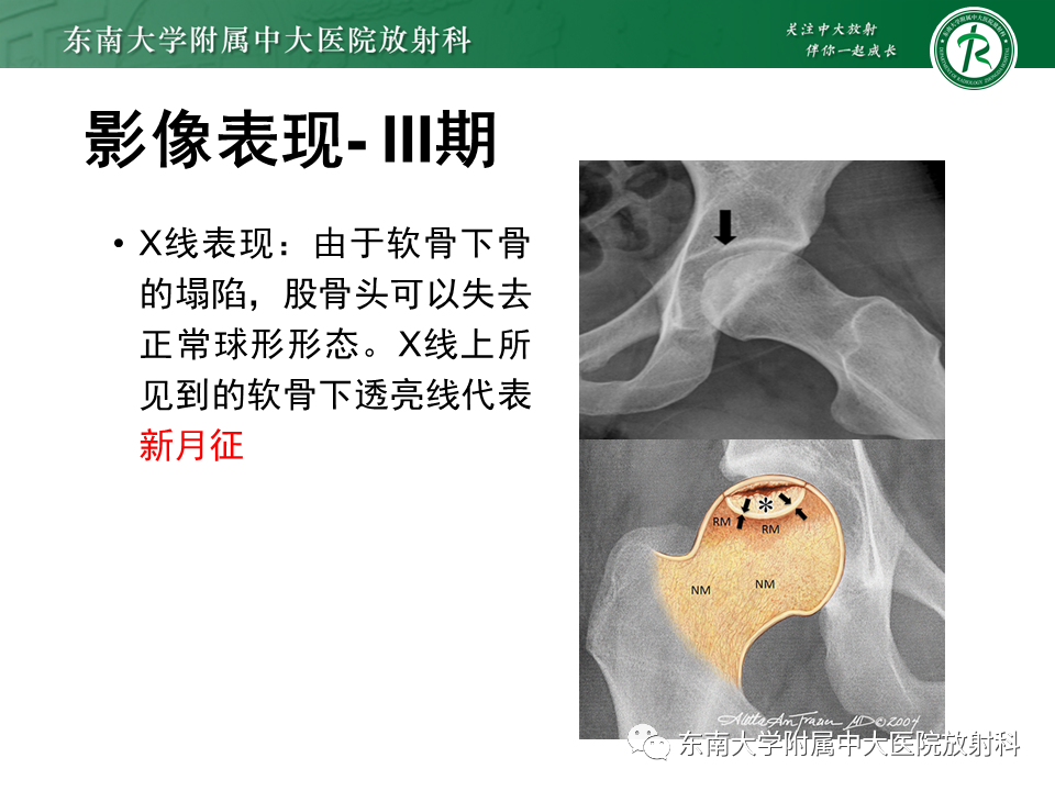 影像PPT - 【PPT】股骨头坏死-19