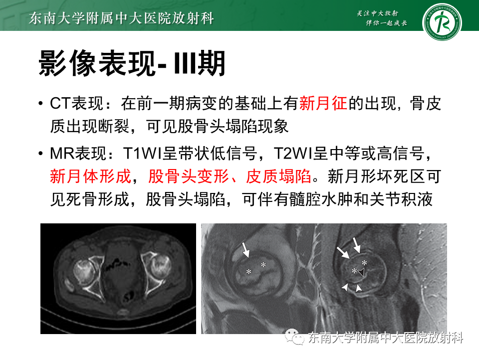 影像PPT - 【PPT】股骨头坏死-20