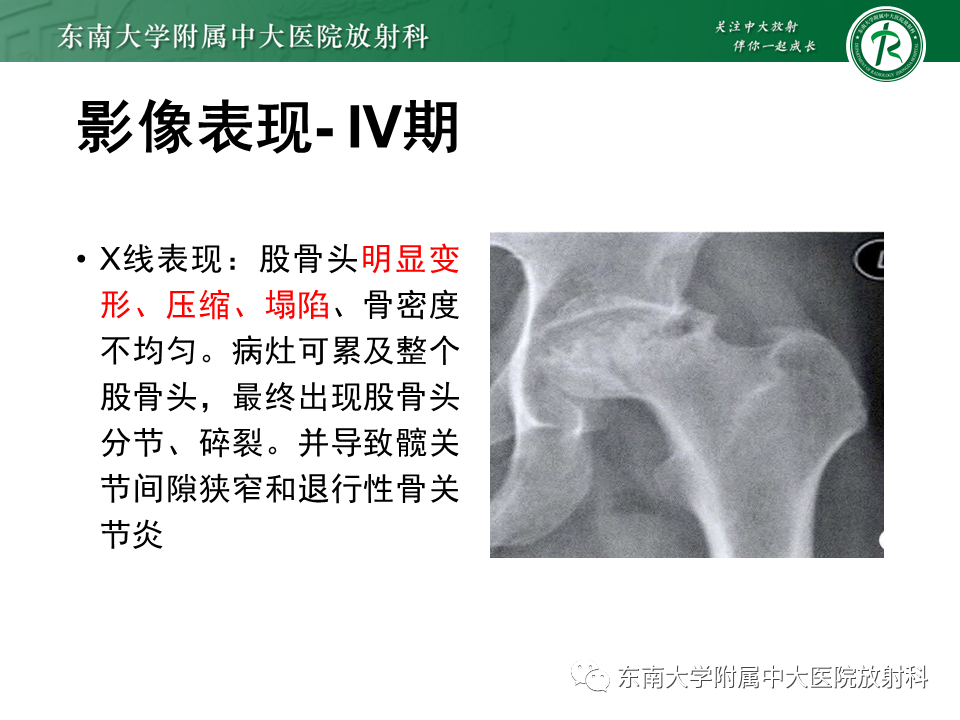 影像PPT - 【PPT】股骨头坏死-21