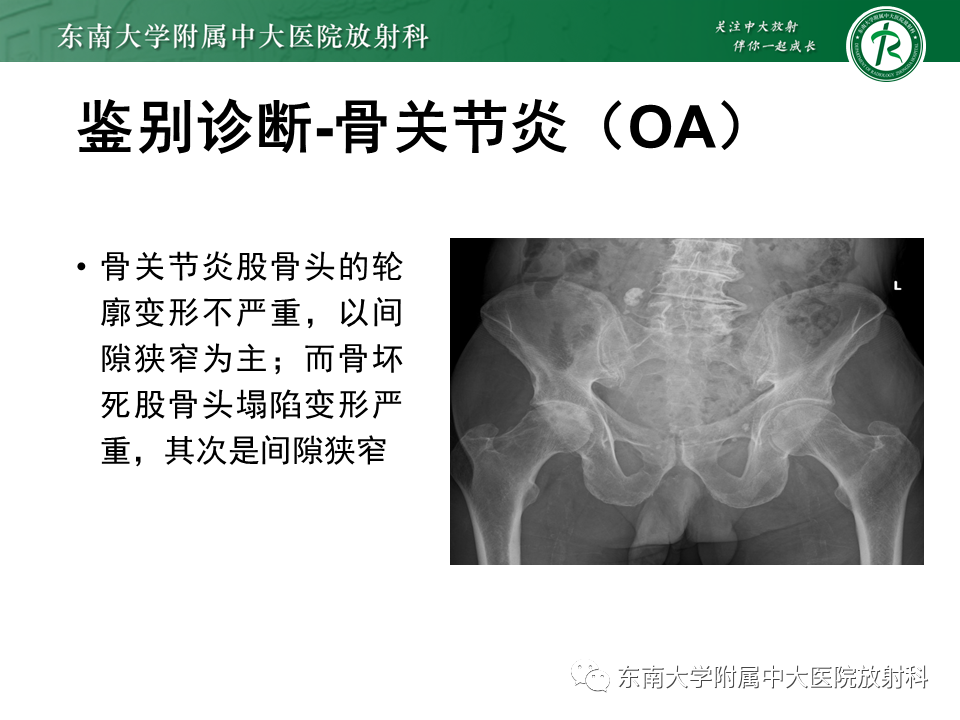 影像PPT - 【PPT】股骨头坏死-26
