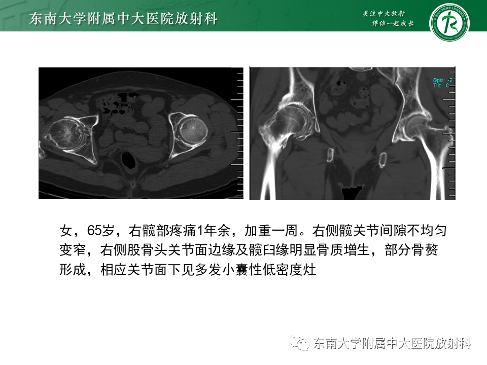 影像PPT - 【PPT】股骨头坏死-27