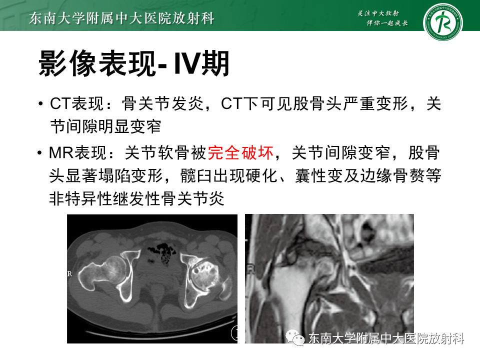 影像PPT - 【PPT】股骨头坏死-22