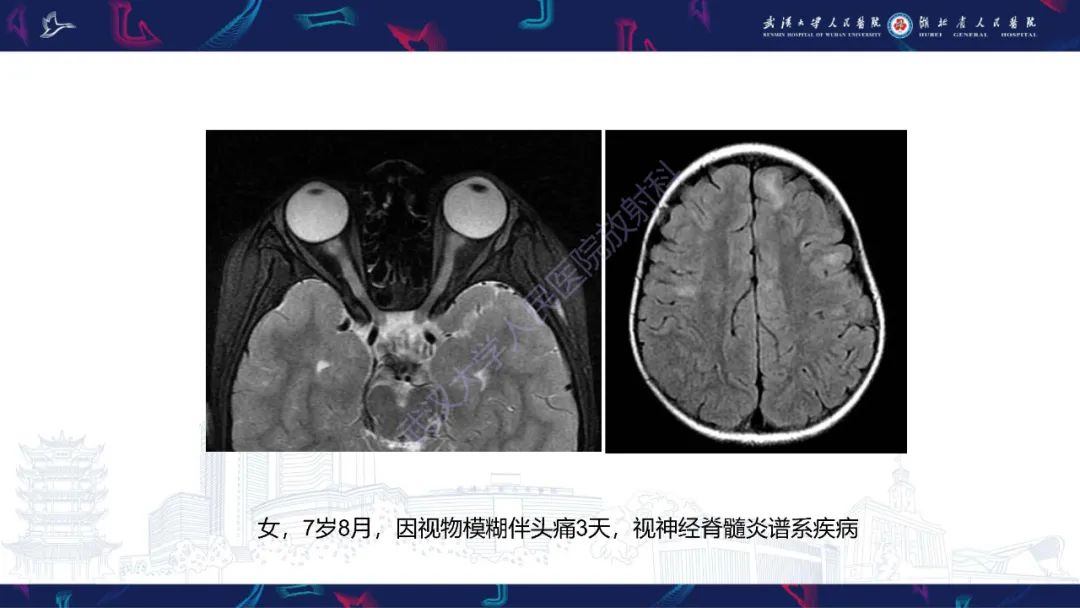 影像PPT - 【PPT】MRI在神经眼科疾病中的应用-13