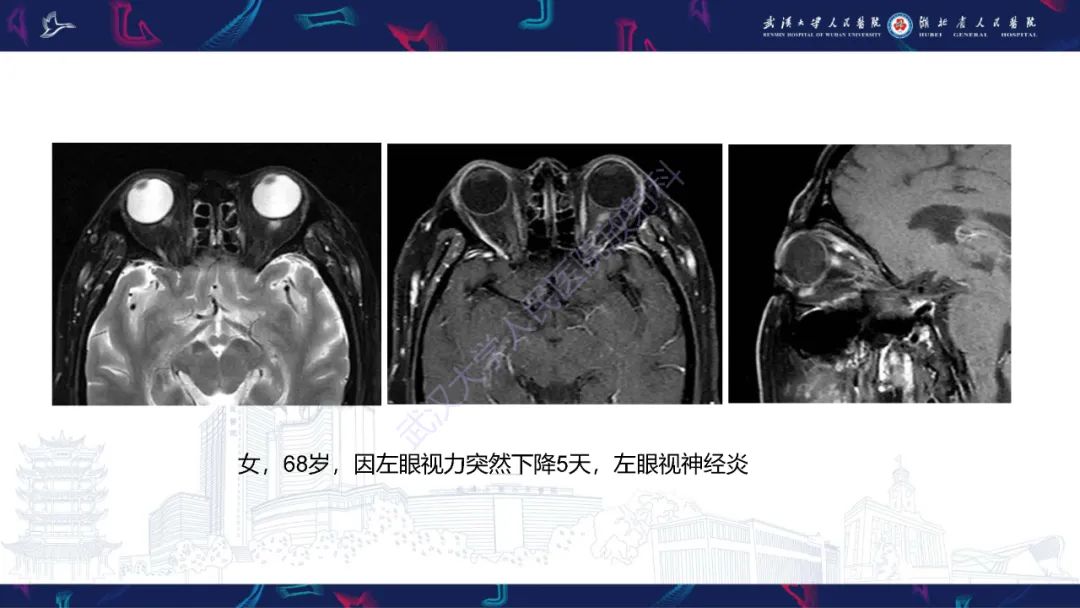 影像PPT - 【PPT】MRI在神经眼科疾病中的应用-15