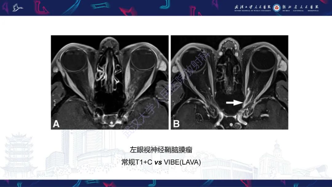 影像PPT - 【PPT】MRI在神经眼科疾病中的应用-17
