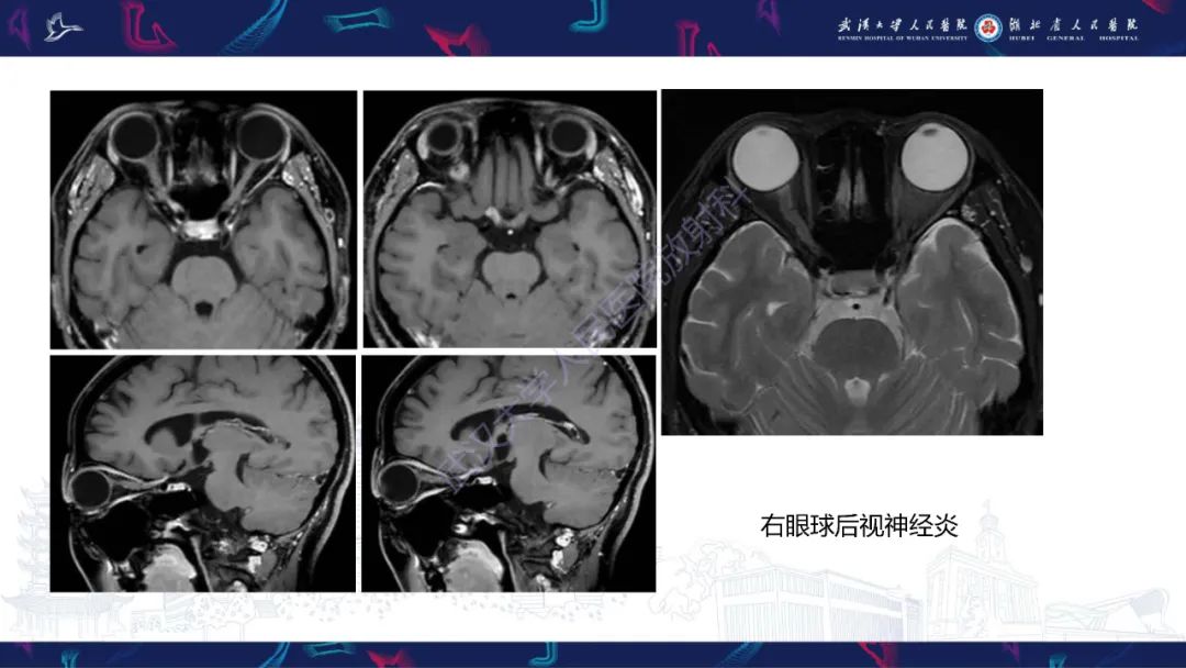 影像PPT - 【PPT】MRI在神经眼科疾病中的应用-18