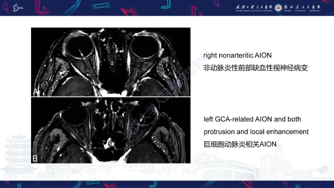 影像PPT - 【PPT】MRI在神经眼科疾病中的应用-21