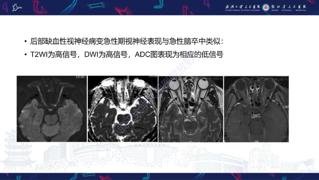 影像PPT - 【PPT】MRI在神经眼科疾病中的应用-22