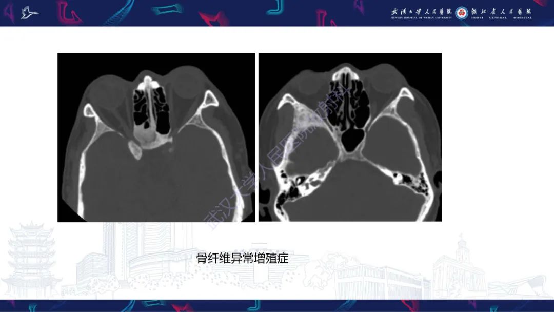 影像PPT - 【PPT】MRI在神经眼科疾病中的应用-24
