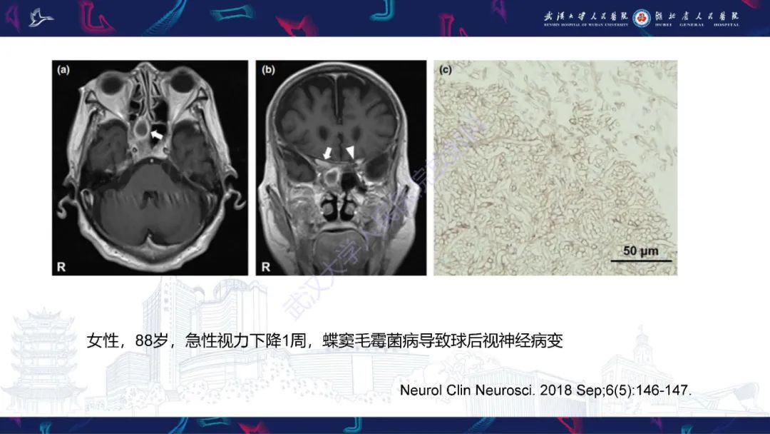 影像PPT - 【PPT】MRI在神经眼科疾病中的应用-27