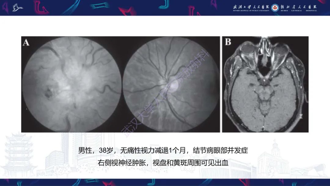影像PPT - 【PPT】MRI在神经眼科疾病中的应用-29