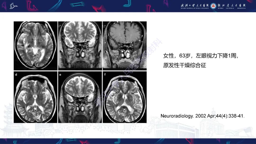 影像PPT - 【PPT】MRI在神经眼科疾病中的应用-30
