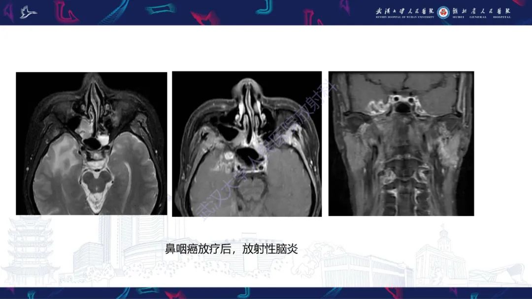 影像PPT - 【PPT】MRI在神经眼科疾病中的应用-32