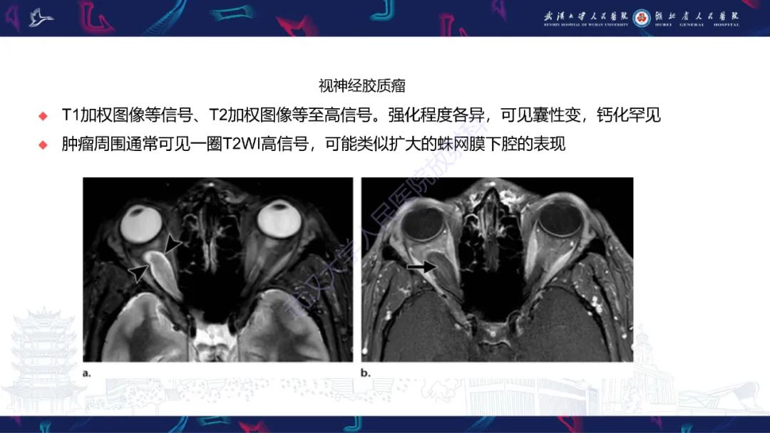 影像PPT - 【PPT】MRI在神经眼科疾病中的应用-36