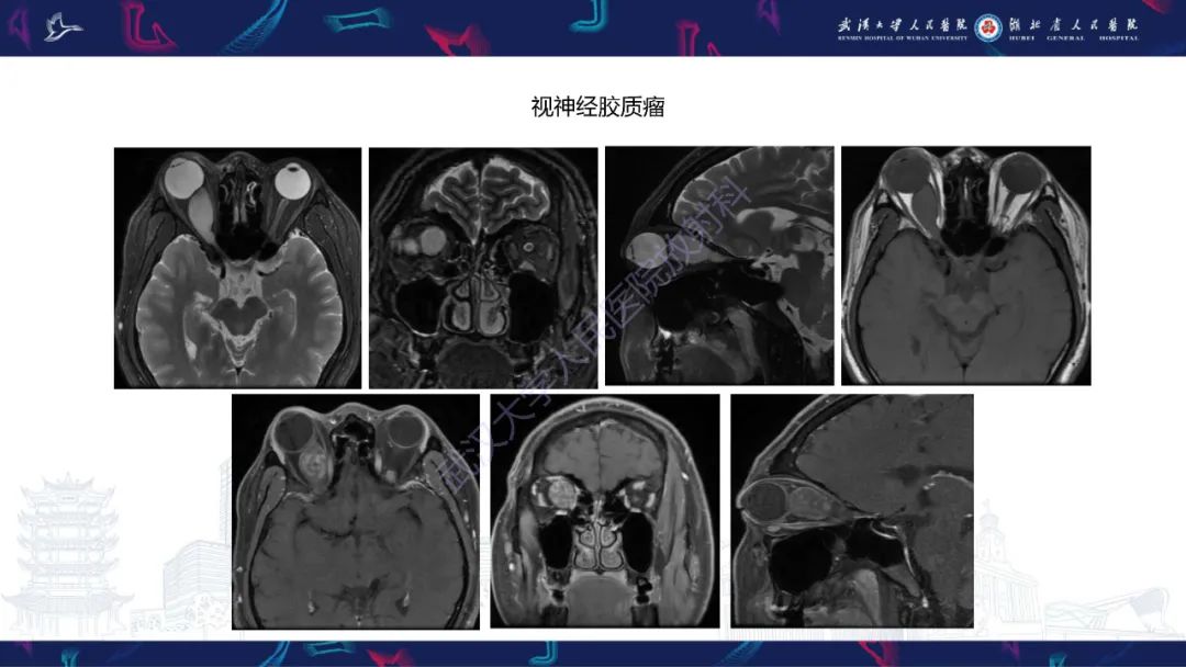 影像PPT - 【PPT】MRI在神经眼科疾病中的应用-37