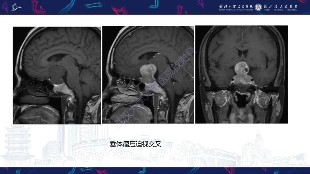 影像PPT - 【PPT】MRI在神经眼科疾病中的应用-39