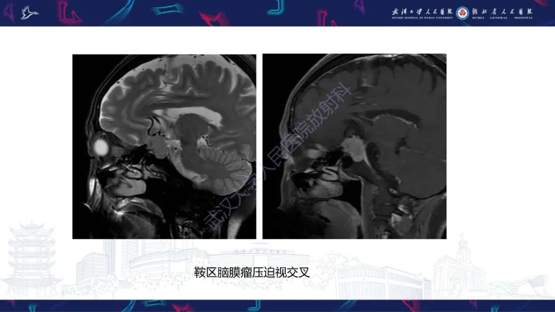 影像PPT - 【PPT】MRI在神经眼科疾病中的应用-40