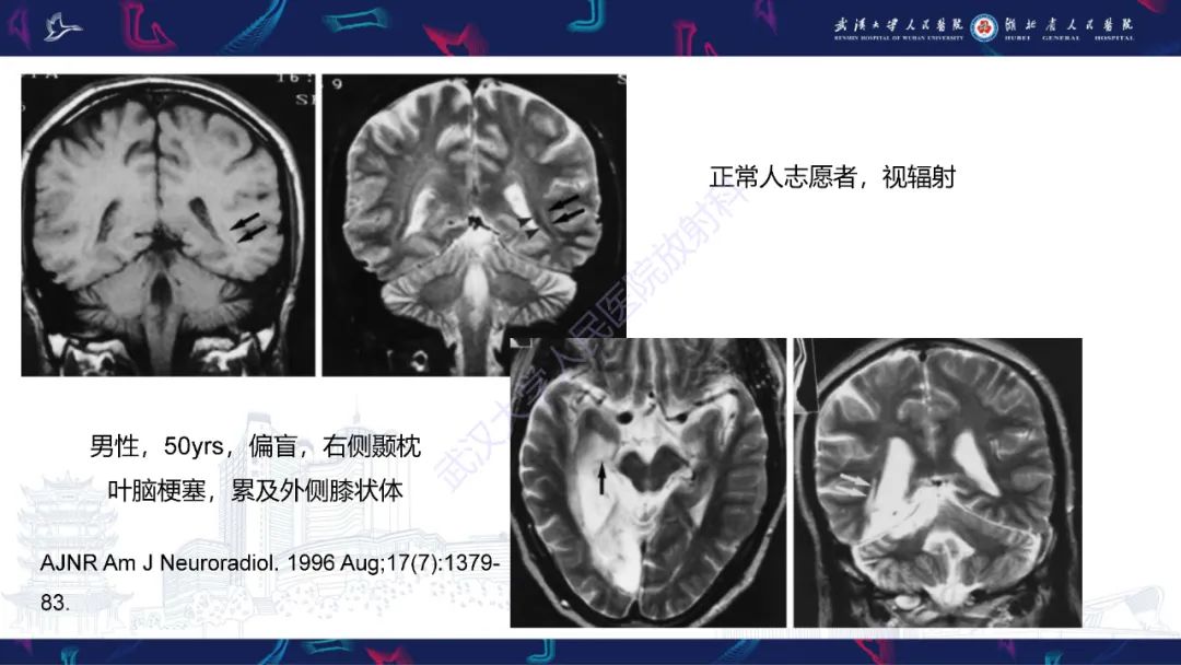影像PPT - 【PPT】MRI在神经眼科疾病中的应用-42