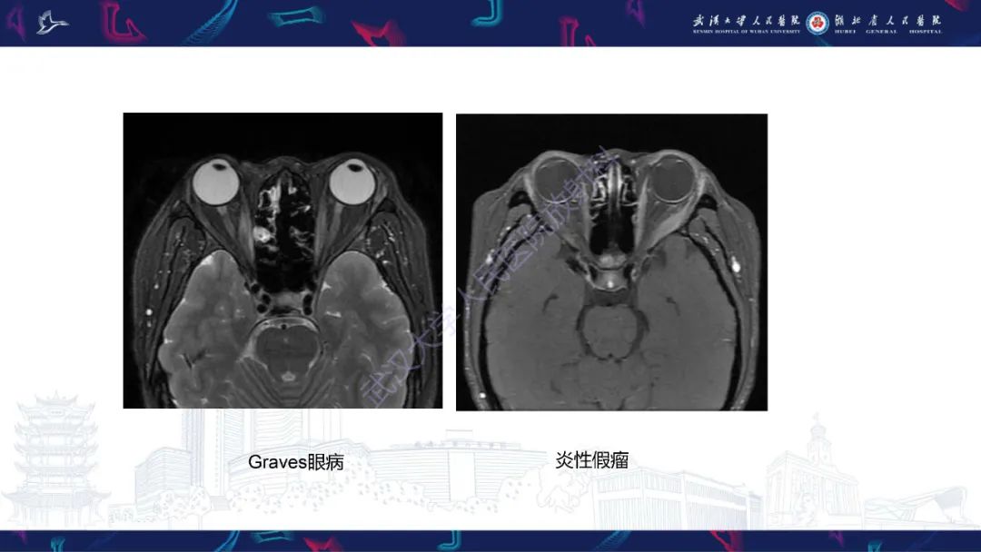 影像PPT - 【PPT】MRI在神经眼科疾病中的应用-49