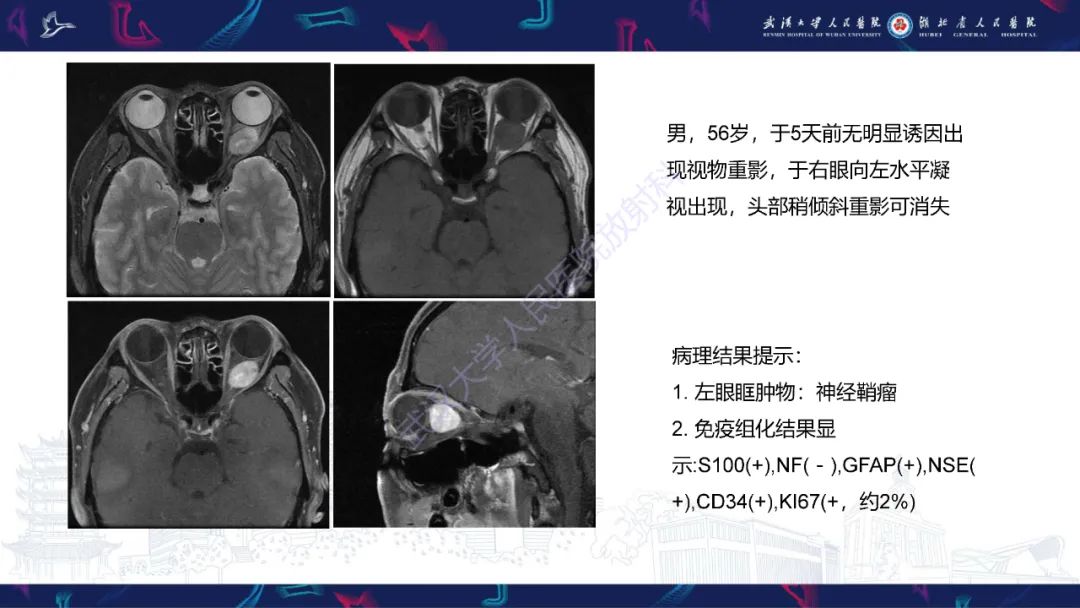影像PPT - 【PPT】MRI在神经眼科疾病中的应用-52