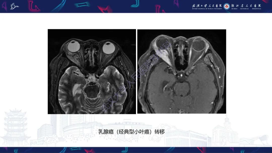 影像PPT - 【PPT】MRI在神经眼科疾病中的应用-53