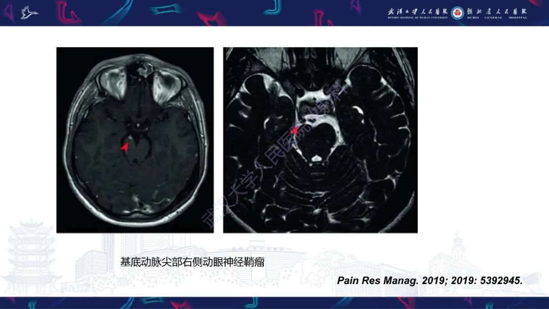 影像PPT - 【PPT】MRI在神经眼科疾病中的应用-60