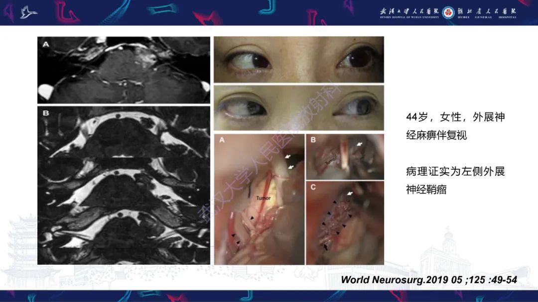 影像PPT - 【PPT】MRI在神经眼科疾病中的应用-65
