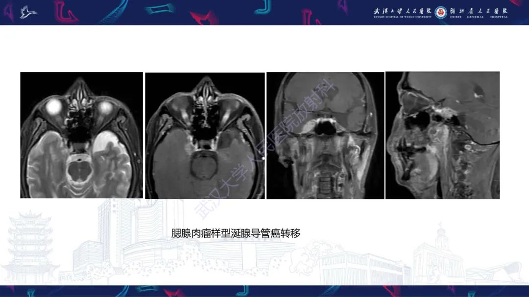 影像PPT - 【PPT】MRI在神经眼科疾病中的应用-70