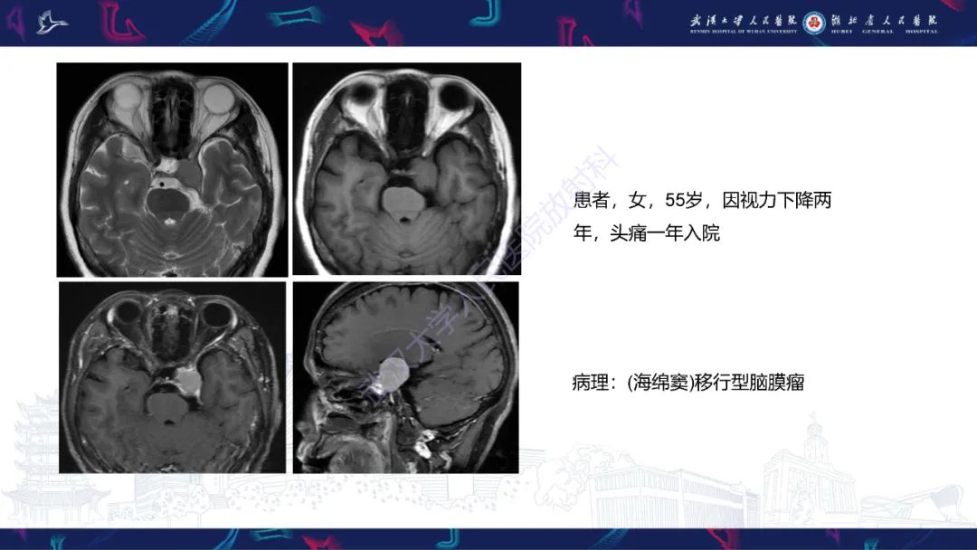 影像PPT - 【PPT】MRI在神经眼科疾病中的应用-72
