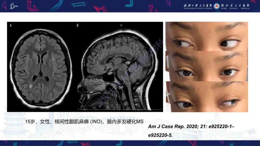 影像PPT - 【PPT】MRI在神经眼科疾病中的应用-76