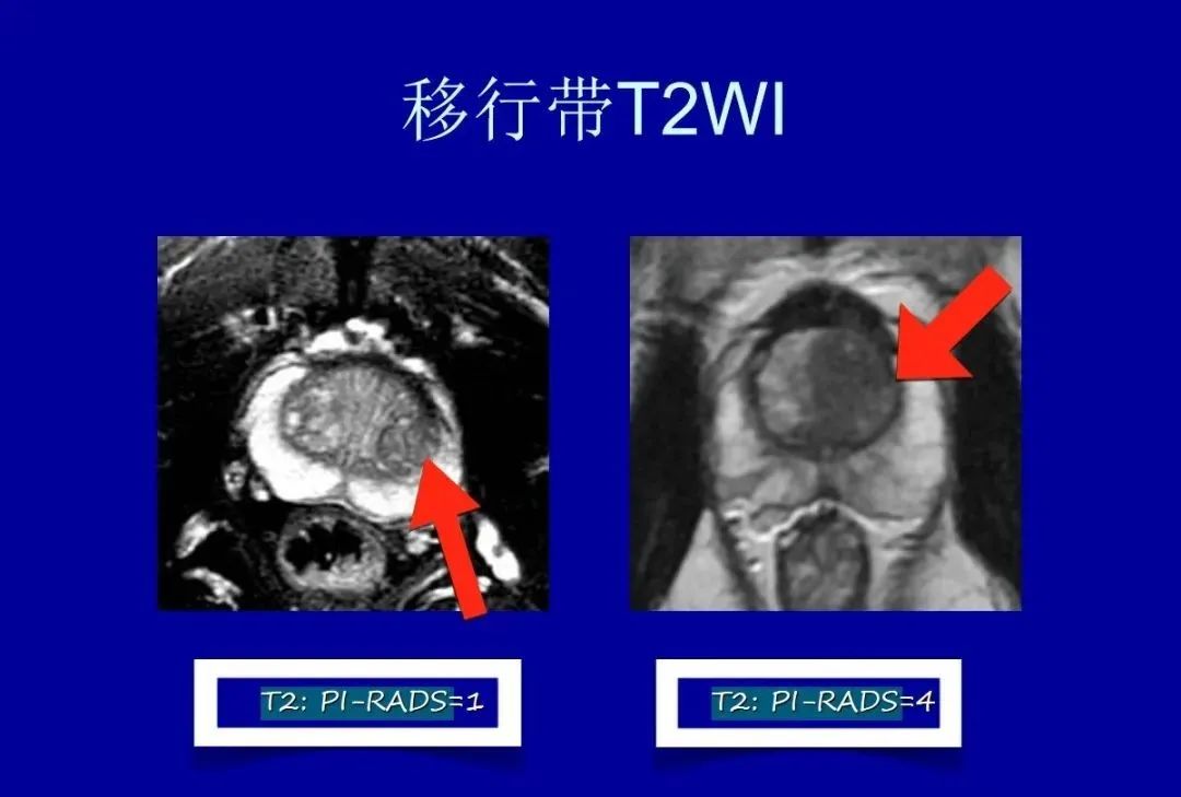 影像PPT - 【PPT】前列腺癌MRI诊断再认识-5
