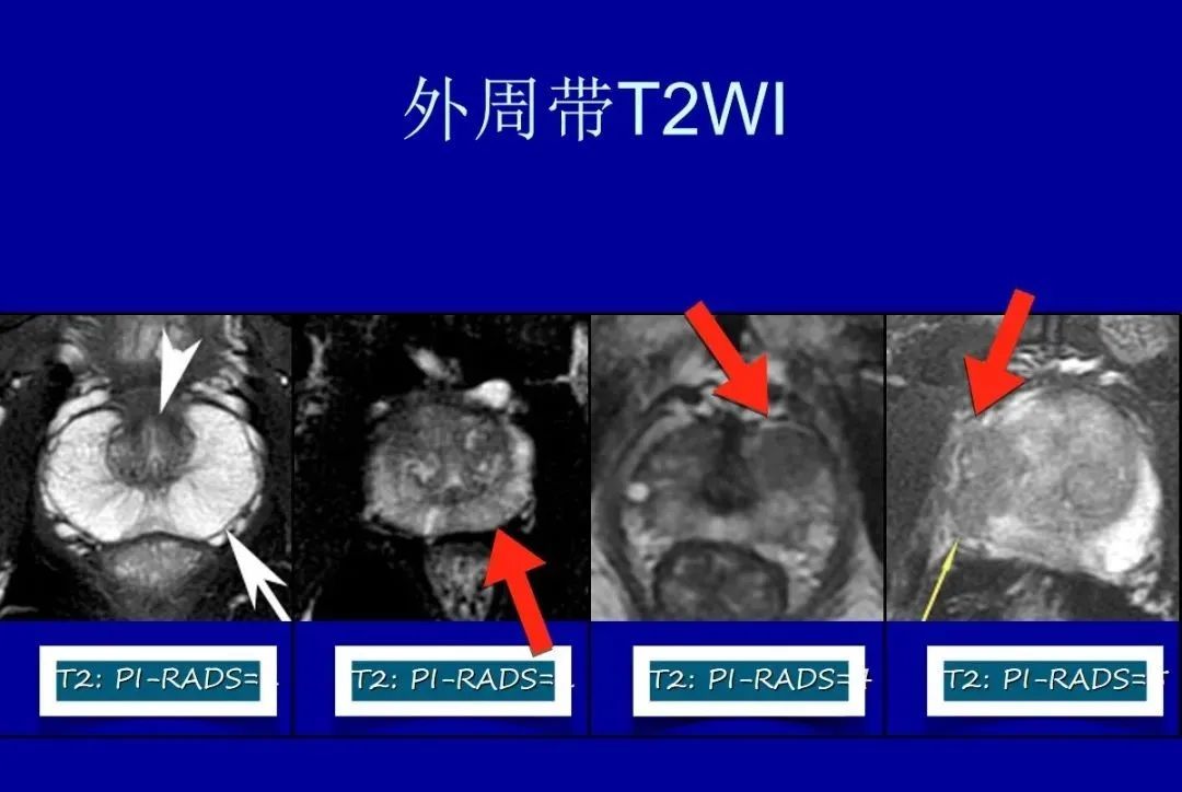 影像PPT - 【PPT】前列腺癌MRI诊断再认识-7