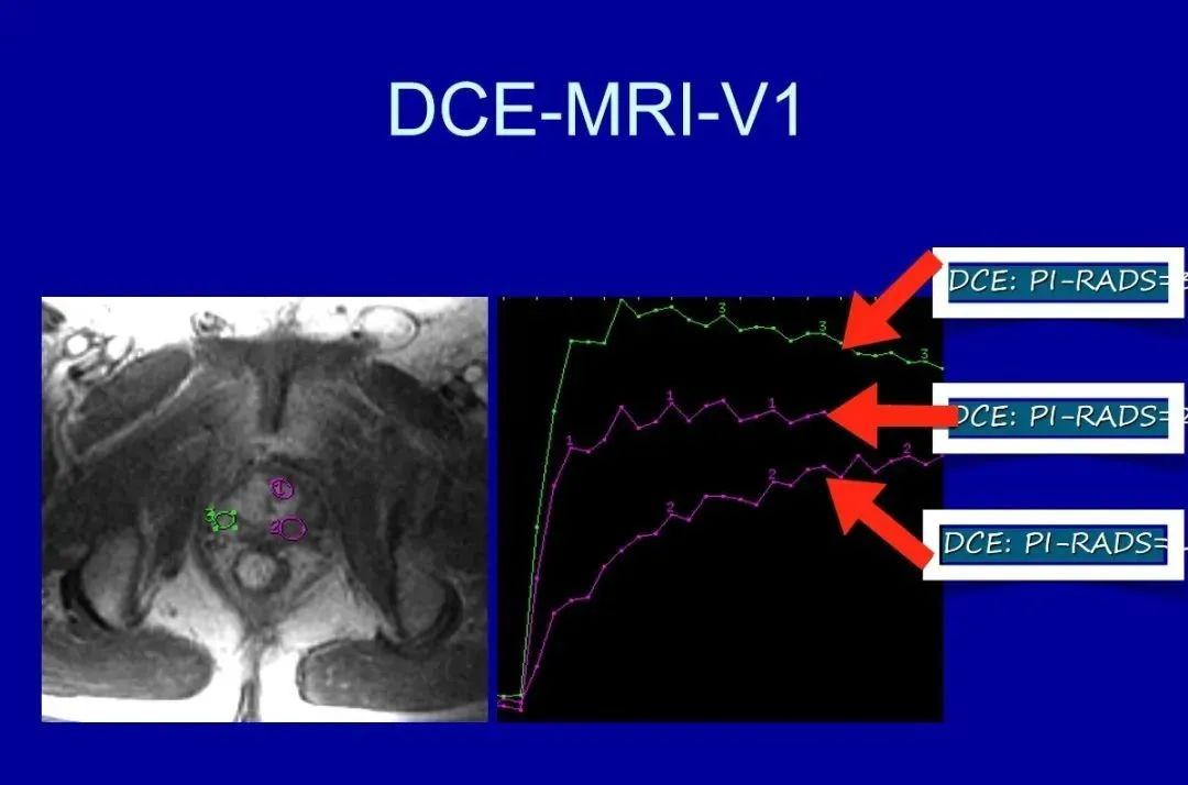 影像PPT - 【PPT】前列腺癌MRI诊断再认识-10