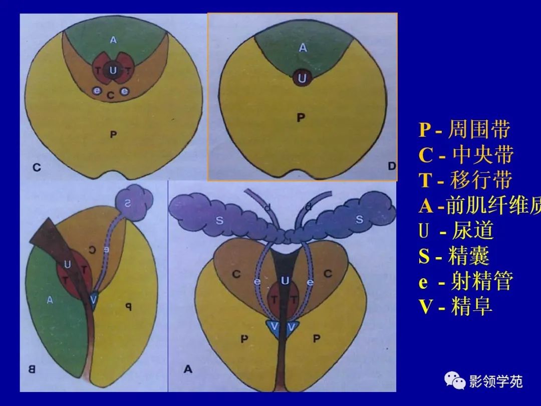 影像PPT - 【PPT】前列腺癌MRI诊断再认识-35