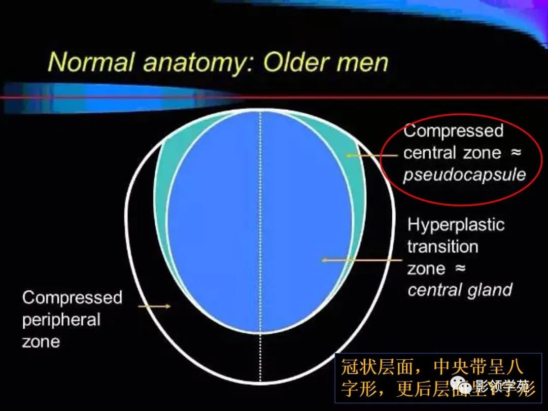 影像PPT - 【PPT】前列腺癌MRI诊断再认识-37
