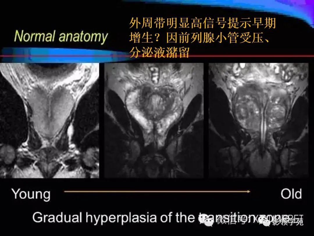 影像PPT - 【PPT】前列腺癌MRI诊断再认识-38