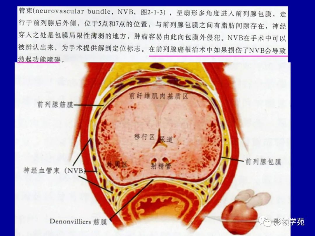 影像PPT - 【PPT】前列腺癌MRI诊断再认识-45
