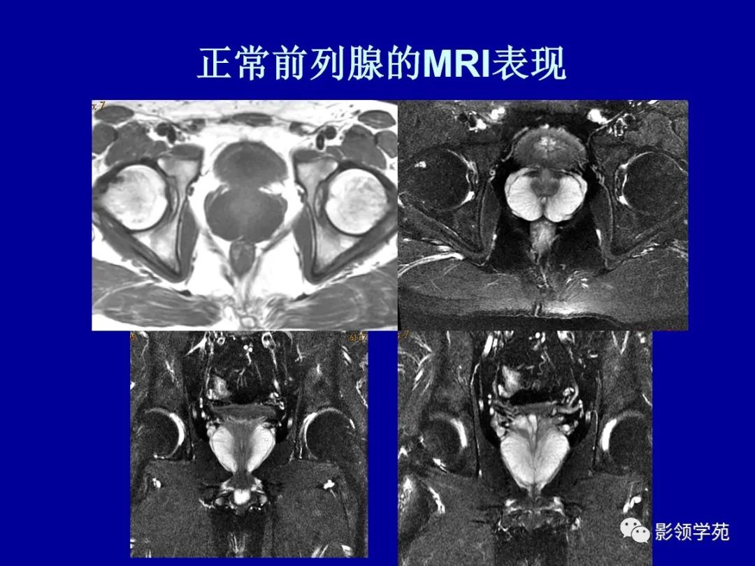 影像PPT - 【PPT】前列腺癌MRI诊断再认识-47