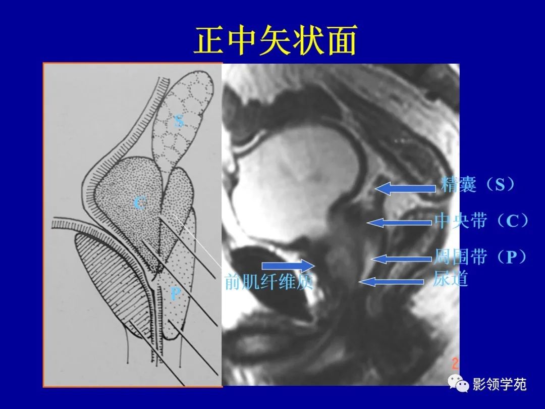 影像PPT - 【PPT】前列腺癌MRI诊断再认识-53